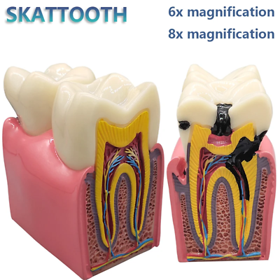 #ad Dental Caries Model Disease Caries Comparation Study teeth Demonstration Model $33.99