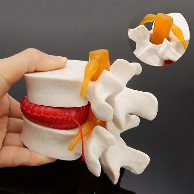 #ad Dental 1:1 Human Anatomy Skeleton Spine Lumbar Disc Herniation Teaching Model $22.00