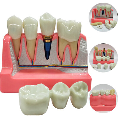 #ad Dental Implant Analysis Crown Bridge Removable Study Demonstration Teeth Model $35.99